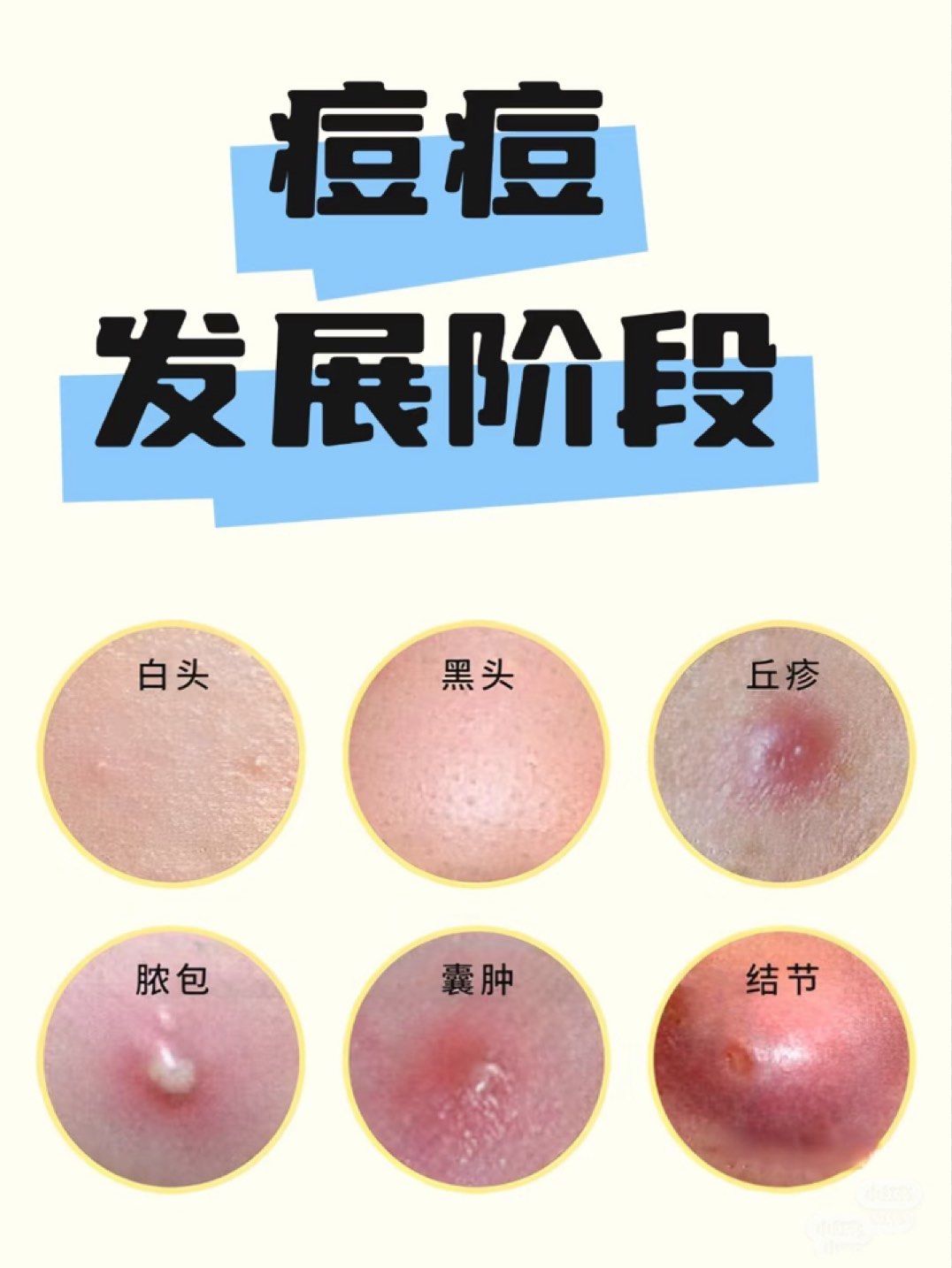 痘痘逐渐变严重的四个阶段,红肿硬包痘
警惕!