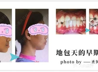 牙齿矫正好处不止一点点