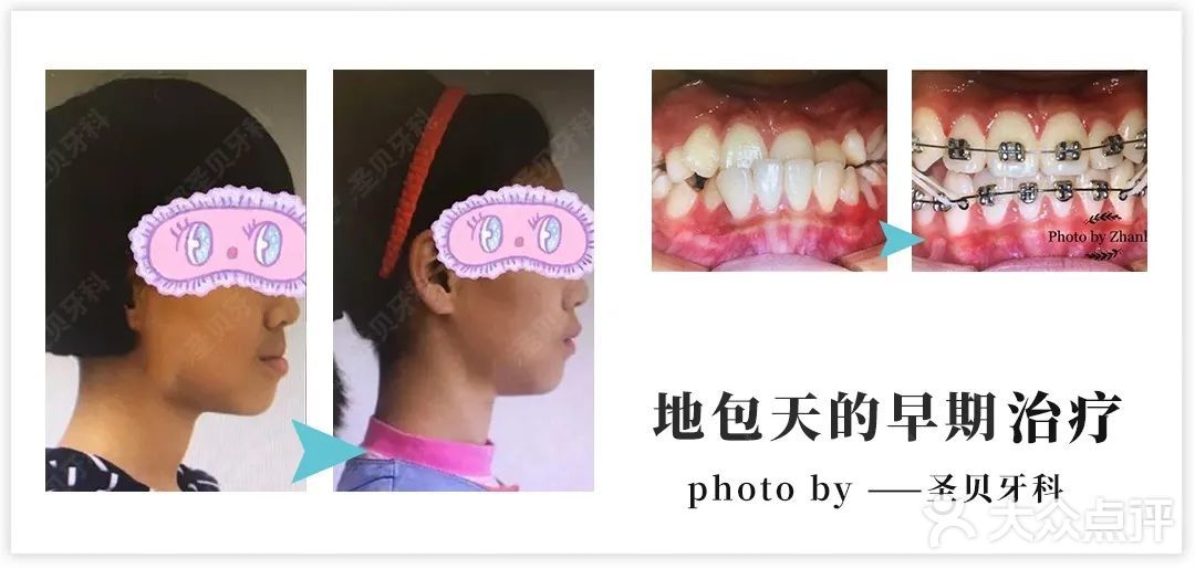 牙齿矫正好处不止一点点