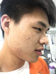 -蕾特恩祛痘•皮肤管理