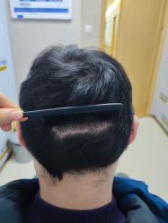 -大麦微针植发丨全国连锁