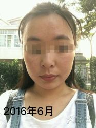 -苗方清颜专业祛痘