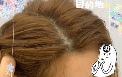 -大麦微针植发全国连锁