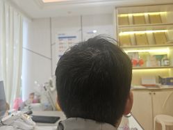 -碧莲盛·不剃发植发