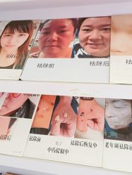 -痣清宫祛斑祛痣连锁店