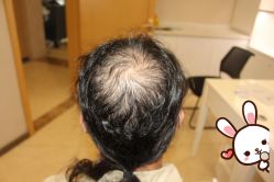 -大麦微针植发丨全国连锁