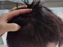 -碧莲盛·不剃发植发