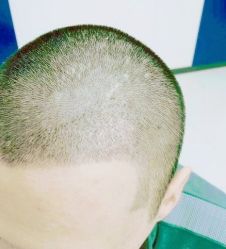 -大麦微针植发丨全国连锁