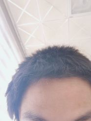 -大麦微针植发丨全国连锁