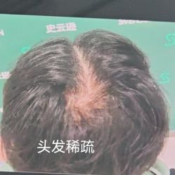 -北京雍禾植发医院