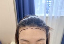 -碧莲盛·不剃发植发