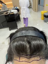 -碧莲盛不剃发植发