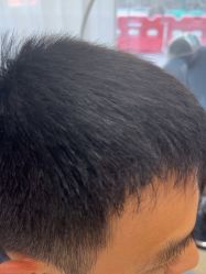-大麦微针植发全国连锁