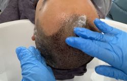 -大麦微针植发全国连锁