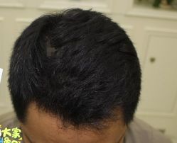 -大麦微针植发丨全国连锁