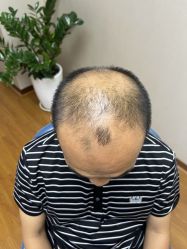 体验前-大麦微针植发全国连锁