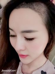 -大麦微针植发丨全国连锁