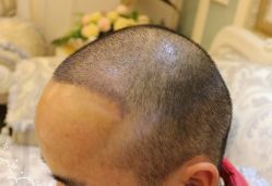 -大麦微针植发丨全国连锁