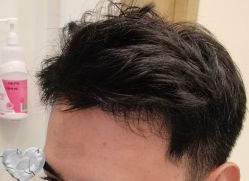 -大麦微针植发丨全国连锁