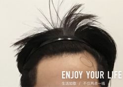 -大麦微针植发全国连锁