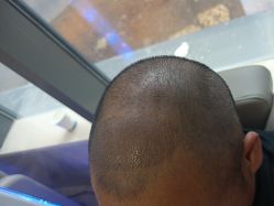 -碧莲盛·不剃发植发