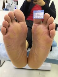 -派恩宜灰指甲鸡眼嵌甲手足癣