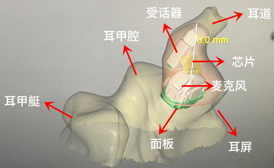 助听器内部结构图图片