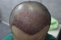 点击看大图 -大麦微针植发丨全国连锁