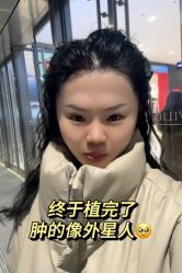 -碧莲盛·不剃发植发