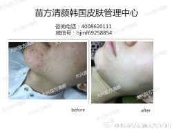 点击看大图 -苗方清颜痘肌研究所