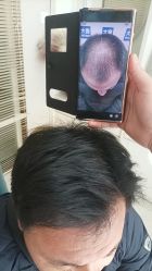 -大麦微针植发丨全国连锁