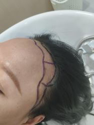 -碧莲盛不剃发植发