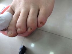 -德哥灰指甲脚气甲沟炎跖疣护理