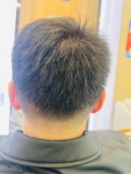 -大麦微针植发丨全国连锁