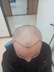 点击看大图 -大麦微针植发丨全国连锁