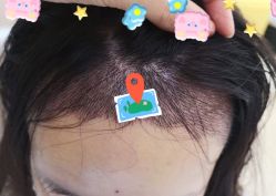 -大麦微针植发全国连锁