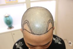 -大麦微针植发丨全国连锁