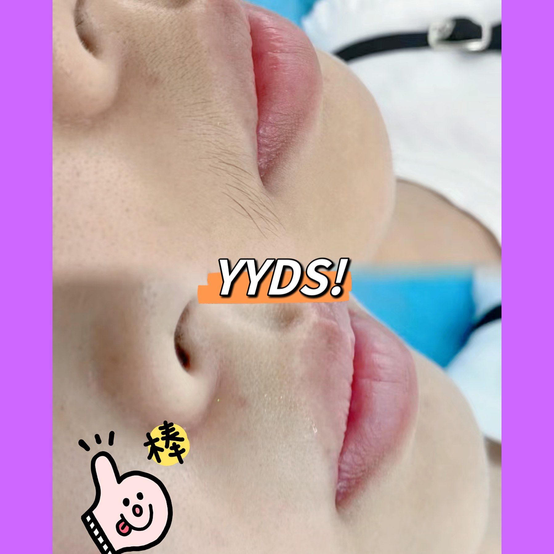 唇部脱毛效果对比90超干净