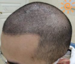 -大麦微针植发丨全国连锁