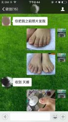 -德哥灰指甲脚气甲沟炎跖疣护理