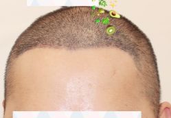 -大麦微针植发全国连锁