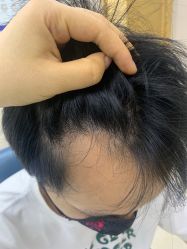 -大麦微针植发丨全国连锁