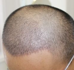 -大麦微针植发丨全国连锁