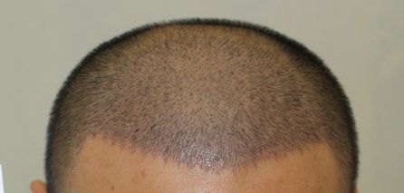 -大麦微针植发丨全国连锁