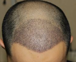 -大麦微针植发全国连锁