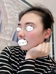 体验后-成都西区医院整形美容