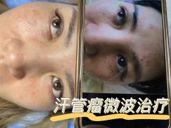 -爱莎扁平疣·汗管瘤·斑痣中心