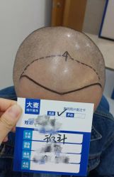 -大麦微针植发全国连锁