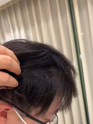 -碧莲盛·不剃发植发
