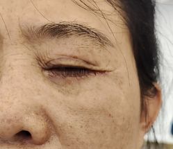 -广州健丽·去眼袋医疗美容机构